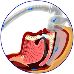 cpap