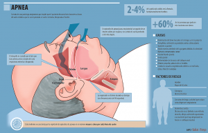 Información sobre la Apnea del sueño - Imagen 01